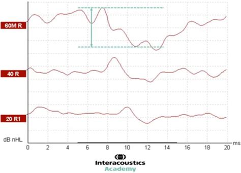 dbehl|Comparison of ABR response amplitude, test time, and .